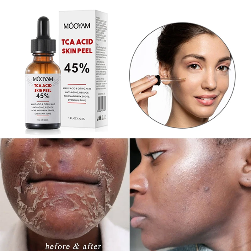 Hyaluronic Acid Serum - Superforce TCA Peel Acid Chemische Peeling