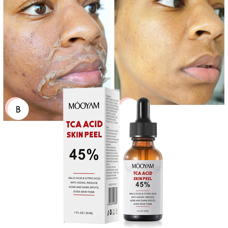 Superforce TCA Peel Acid Chemi - Hyaluronic Acid Serum recensie en prijs