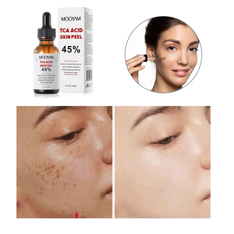 Superforce TCA Peel Acid Chemi - Hyaluronic Acid Serum recensie en prijs